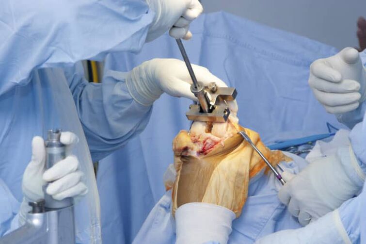 хирургия на артроза на колянната става