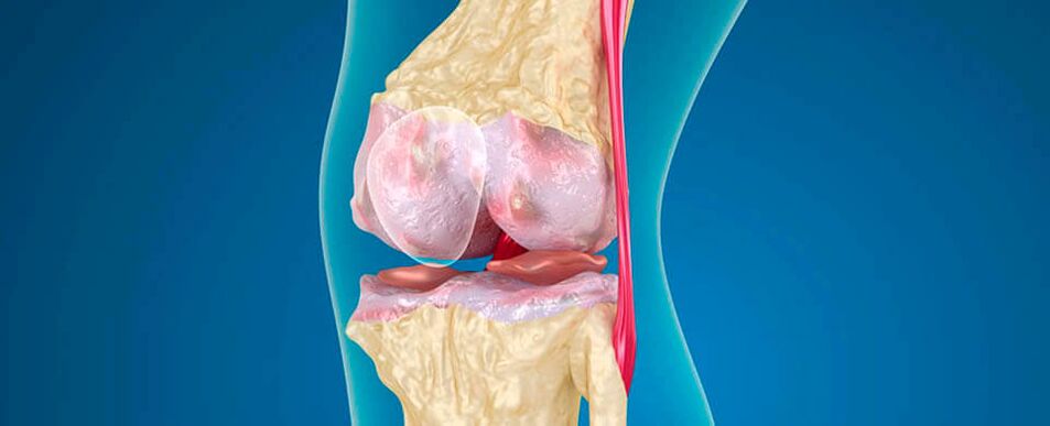 артроза на коляното като причина за болка