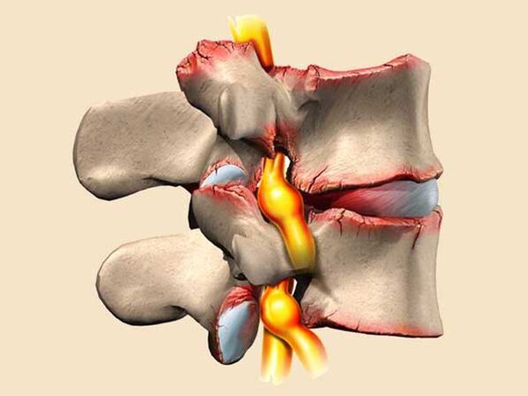 увреждане на гръбначния стълб при гръдна остеохондроза