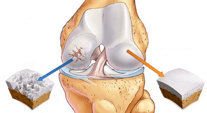 здрав хрущял и хрущял, засегнат от артроза