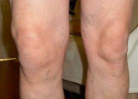 симптоми на коляното