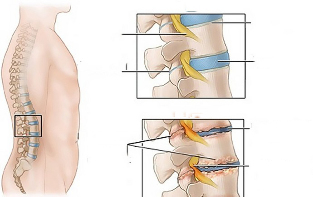 как изглежда остеохондрозата на гръдната област